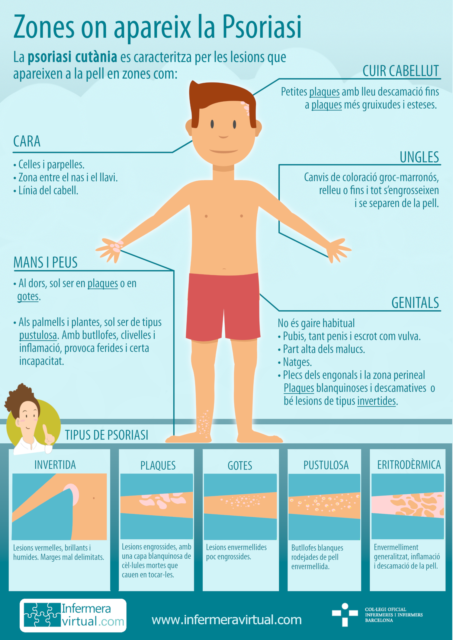 Infografies Zones de psoriasi