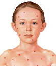 Niño con síntomas de sarampión